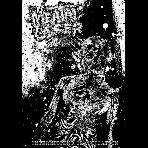 Meatal Ulcer - Intermittent Claudication (Vinyl)