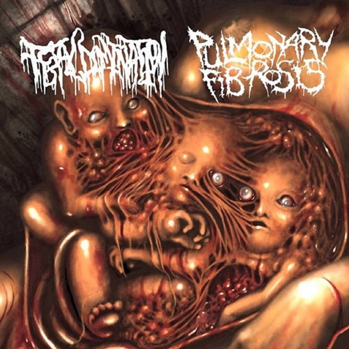 Pulmonary Fibrosis / Fetal Domination - Split