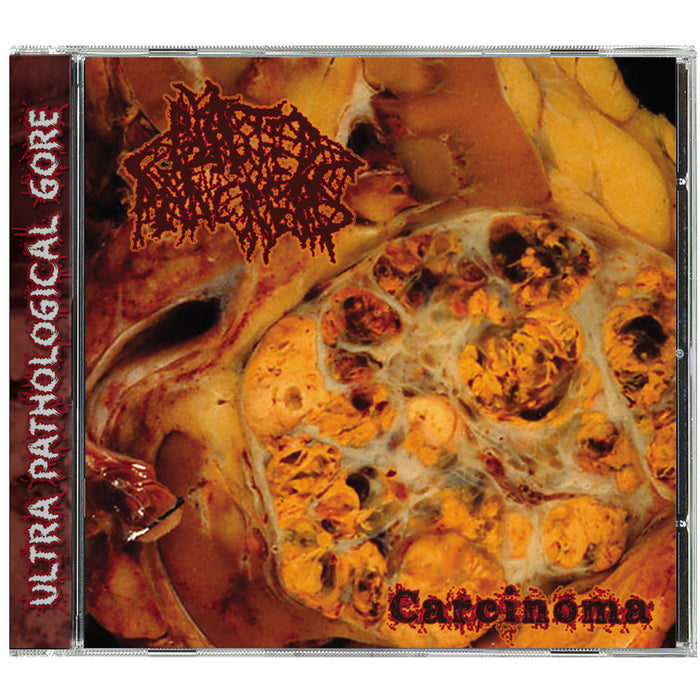 Blasted Pancreas - Carcinoma